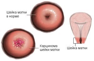 Плоскоклеточная метаплазия шейки матки: что это такое, лечение, признаки, симптомы, причины Плоскоклеточная метаплазия шейки матки: что это такое, лечение, признаки, симптомы, причины