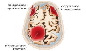 Эпидуральное и субдуральное кровоизлияние головного мозга: последствия, симптомы, лечение, признаки, причины