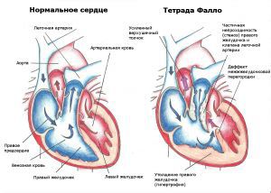 Порок сердца Тетрада Фалло: лечение, прогноз, признаки, симптомы, причины