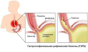 Гастроэзофагеальный рефлюкс (ГЭР) у детей: симптомы, лечение, причины, признаки Гастроэзофагеальный рефлюкс (ГЭР) у детей: симптомы, лечение, причины, признаки