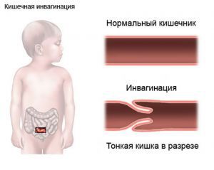 Инвагинация кишечника у детей: причины, симптомы, лечение, признаки