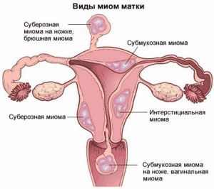 Чем опасна миома матки больших размеров если не лечить, риски