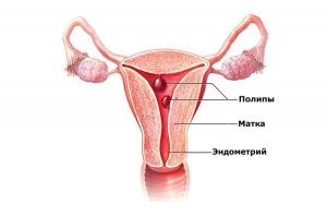 Полип эндометрия в матке: что это такое, причины, симптомы, признаки, лечение