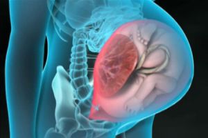 Врастание предлежащей плаценты