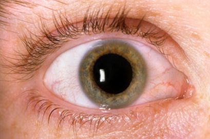 Поражение органов зрения при лимфопролиферативных заболеваниях