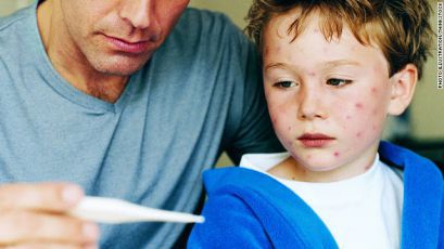 Аллергия на ядовитый плющ у детей, симптомы, причины, лечение