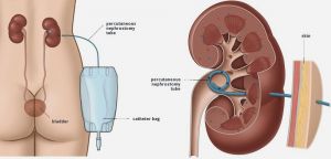 Чрескожная нефростомия: показания, техника
