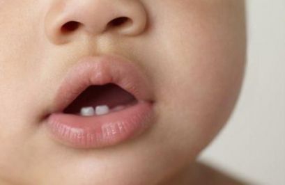 Прорезывание зубов у детей (грудничков, младенцев): симптомы, признаки