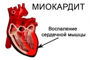 Острый миокардит: что это такое, симптомы, лечение, причины, признаки Острый миокардит: что это такое, симптомы, лечение, причины, признаки