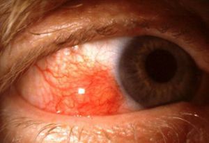 Эписклерит глаза: лечение, симптомы, причины