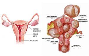 Миома матки и гиперплазия эндометрия: что это такое, признаки, симптомы, лечение, причины
