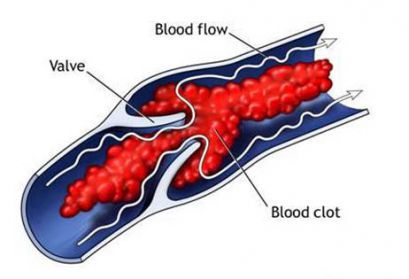 Роль морфологических и функциональных факторов в развитии тромбозов
