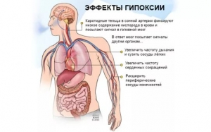 Гипоксия: что это такое, симптомы, лечение, причины, признаки, последствия, профилактика