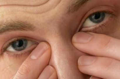 Синдром сухого глаза, лечение, симптомы, причины