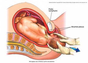 Дистоция плечиков в родах: как избежать