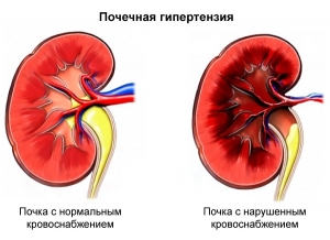 Почечная гипертензия: что это такое, лечение, симптомы, причины, признаки