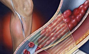 Острый тромбоз глубоких вен нижних конечностей: лечение, симптомы