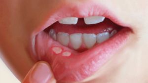 Язвы полости рта: причины, лечение
