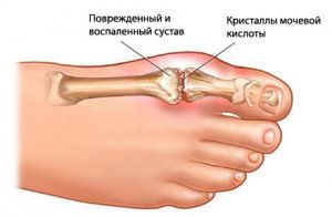 Подагрический артрит суставов: лечение, симптомы, признаки, причины