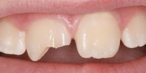 Сломанные и оторванные зубы