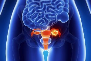 Смешанные эпителиальные и мезенхимальные опухоли тела матки: лечение, прогноз, признаки, причины, симптомы