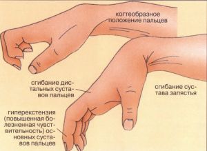 Контрактура сустава: что это такое, лечение, симптомы, причины, профилактика, признаки Контрактура сустава: что это такое, лечение, симптомы, причины, профилактика, признаки