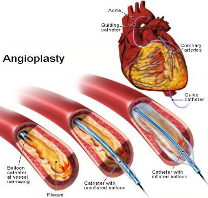 Коронарная ангиопластика