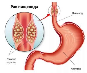 Опухоли пищевода: что это такое, симптомы, лечение, признаки, причины