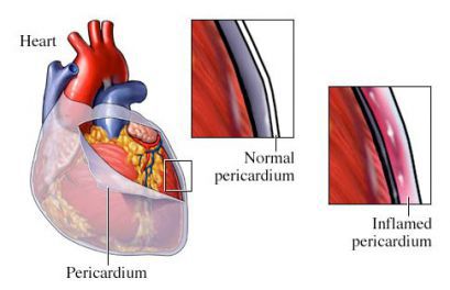 Перикардит сердца: что это такое, лечение, симптомы, причины, признаки