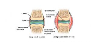 Сустав как комплексная многокомпонентная система Сустав как комплексная многокомпонентная система