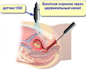 Анализ ворсин хориона