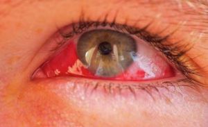 Гемофтальм глаза: лечение, причины, классификация, симптомы
