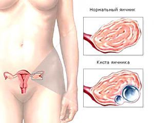 Киста яичника у женщин: что это такое, симптомы, лечение, причины, признаки