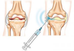 Основные препараты, применяемые для внутрисуставных и периартикулярных инъекций
