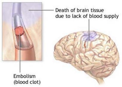 Субарахноидальные кровоизлияния: последствия, лечение, симптомы, признаки, причины