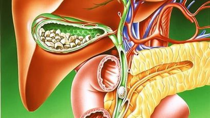 Желчнокаменная болезнь: симптомы, лечение, признаки, причины. Камни в желчном пузыре