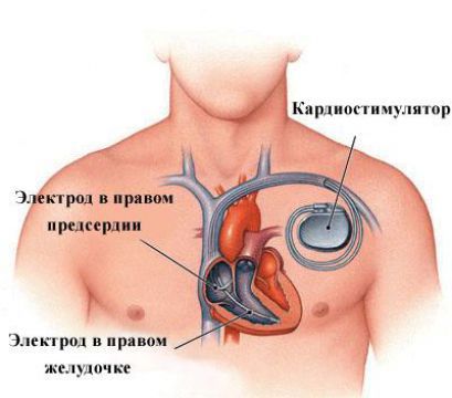 Экстрасистолия сердца, желудочка, лечение, причины, симптомы