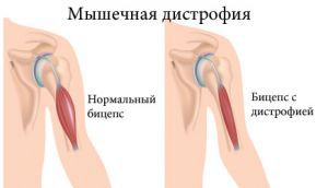Мышечная дистрофия: лечение, симптомы, прогноз, признаки, причины Мышечная дистрофия: лечение, симптомы, прогноз, признаки, причины