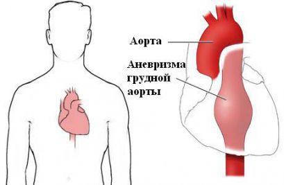 Аневризма аорты: что это такое, лечение, симптомы, причины, признаки