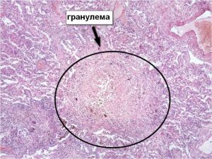 Гранулемы печени Гранулемы печени