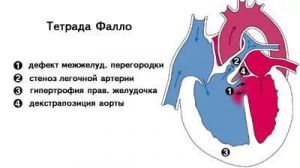 Порок сердца Тетрада Фалло: что это такое, лечение, причины, симптомы, признаки