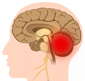 Поражения мозжечка головного мозга: симптомы, лечение, причины, признаки
