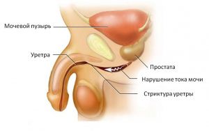 Инородные тела уретры и полового члена: лечение