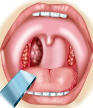 Опухоли глотки: симптомы, лечение, причины, признаки