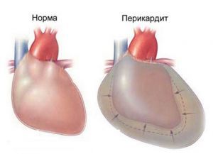 Острый перикардит: что это такое, симптомы, лечение, причины, признаки