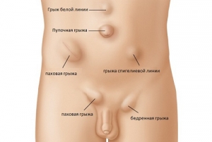 Наружные грыжи живота: что это такое, классификация