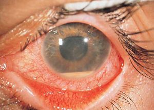 Токсическое поражение сетчатки глаза