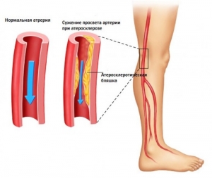 Заболевания периферических артерий: лечение, причины, симптомы, признаки
