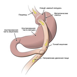 Болезни оперированного желудка: что это такое, лечение, причины, симптомы, признаки