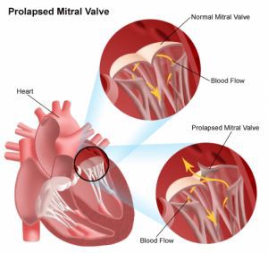 Пороки митрального клапана сердца: лечение, симптомы